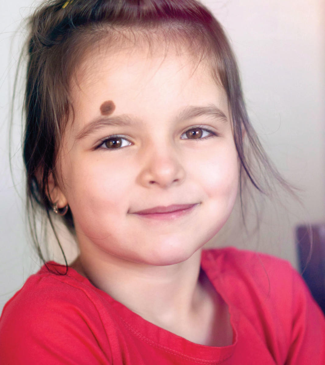 New Melanoma and Nevus Clinic Opens St. Louis Children's Hospital